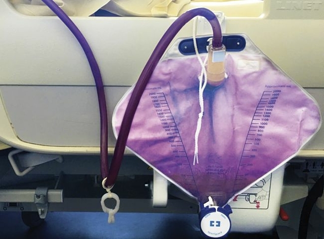 Túi nước tiểu màu tím của bệnh nhân. Ảnh: The New England Journal of Medicine 2019