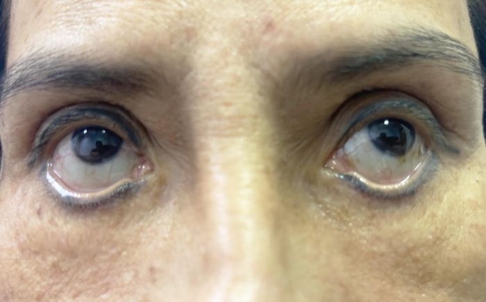 Cả 2 mắt của bệnh nhân bị lật mí không thể nhắm lại sau phẫu thuật ở Spa 