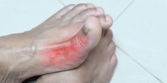 Bệnh gout gây ra các cơn đau dữ dội và đột ngột ở các khớp.
